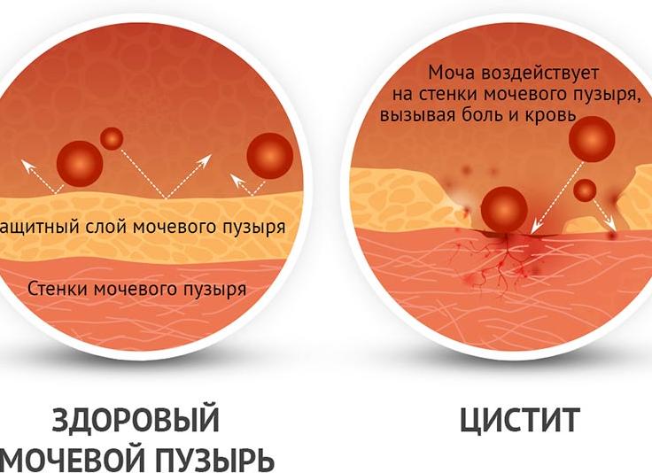 Моча при цистите у женщин Моча при цистите у женщин