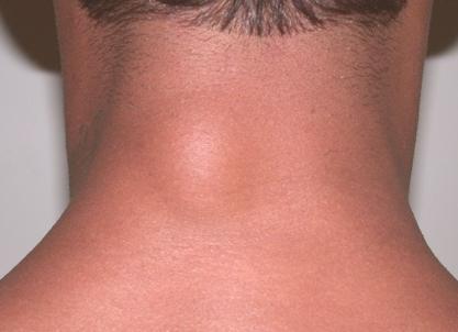 Липома на шее сзади Липома на шее сзади