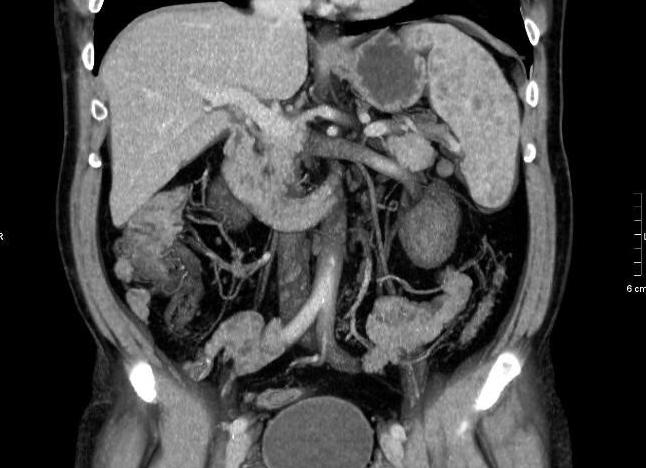 Кт органов брюшной полости с болюсным контрастированием