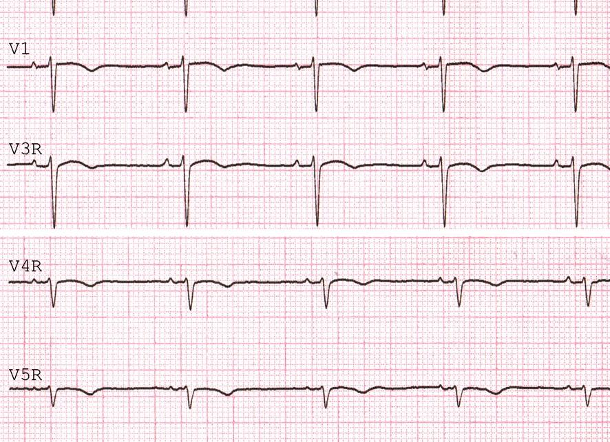 Кардиограмма здорового сердца человека