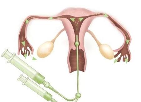 Гсг маточных труб на какой день цикла делают
