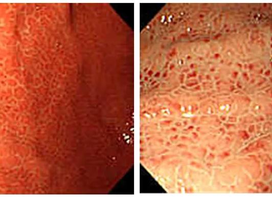 Гиперемическая гастропатия что это такое Гиперемическая гастропатия что это такое