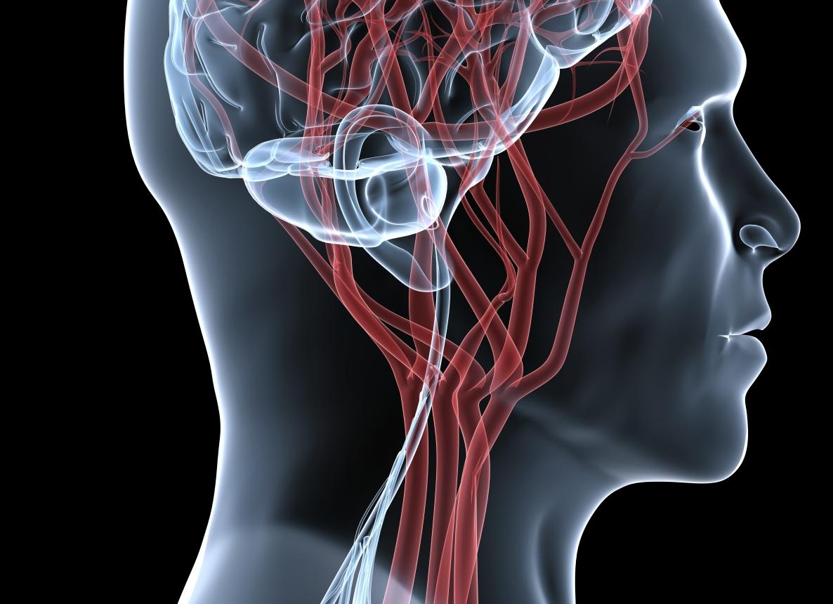 Экстракраниальные сосуды это