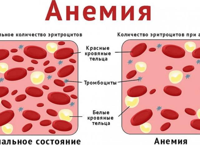 Диагностика анемий сывороточное железо