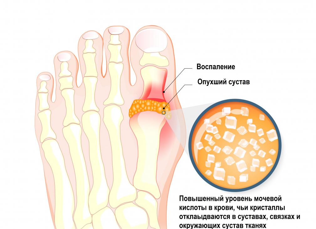 Что такое мочевая кислота