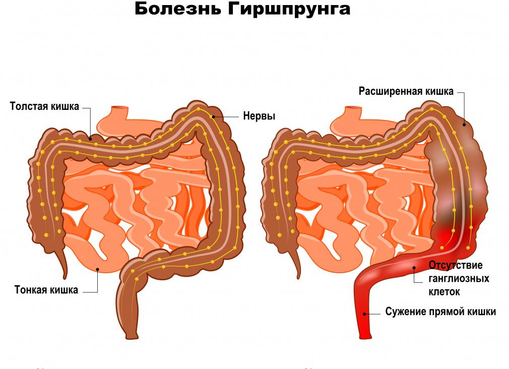 Болезни толстого кишечника