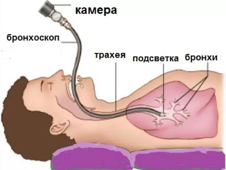 Как делают бронхоскопию бронхов