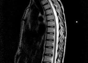 Мрт грудного отдела позвоночника что покажет Мрт грудного отдела позвоночника что покажет