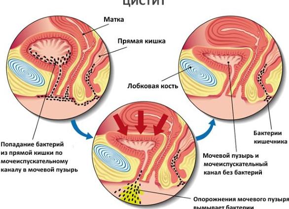 Моча при цистите Моча при цистите