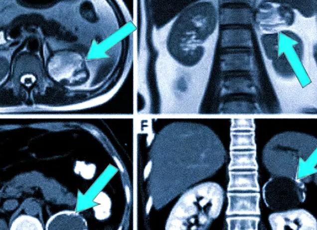 Кт с контрастированием почек