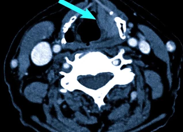 Кт мягких тканей шеи что показывает