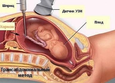 Кровь на патологию плода