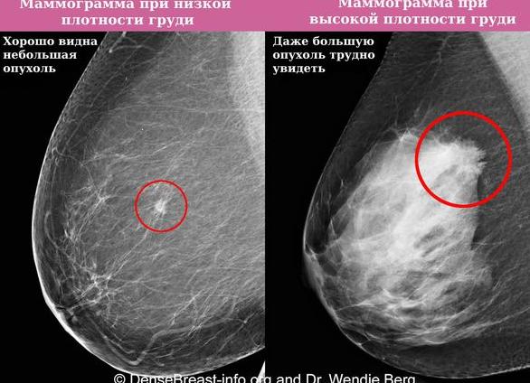 Инволюция молочных желез