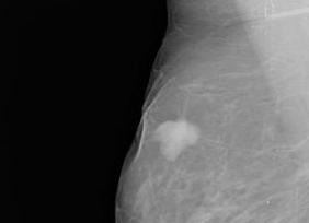 Инфильтрат молочной железы что это такое