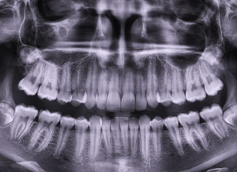 Фото рентген зубов