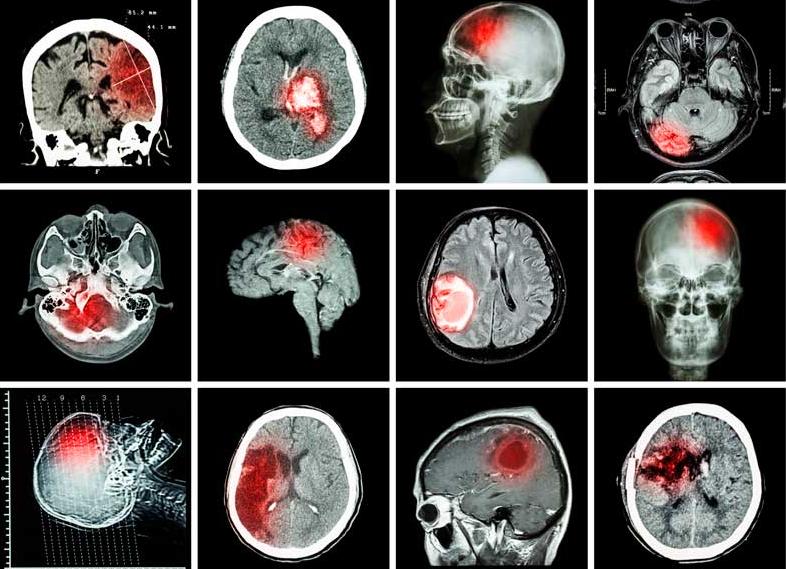 Что такое скт головного мозга Что такое скт головного мозга