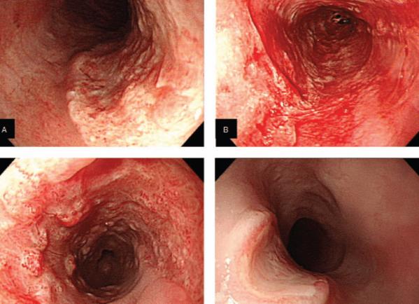 Что такое инфекция цмв