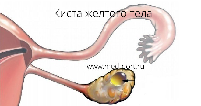 Кистозное желтое тело в правом яичнике