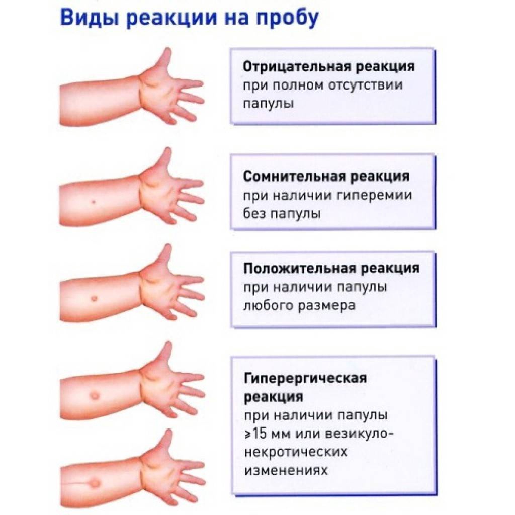 Манту для чего