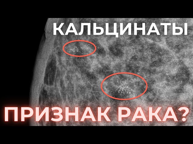 Микрокальцинаты в молочной железе что это такое