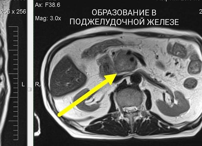 Мрт печени и поджелудочной железы что показывает