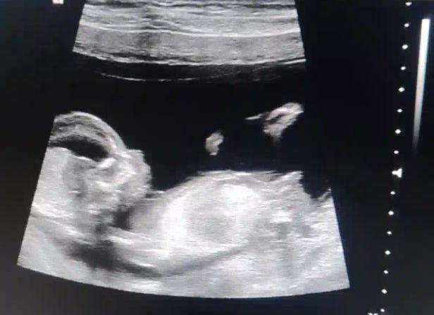 Может ли ошибаться узи