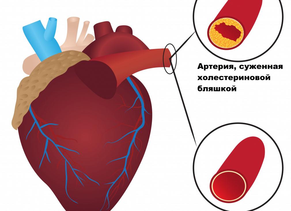 Лпонп повышены что это значит