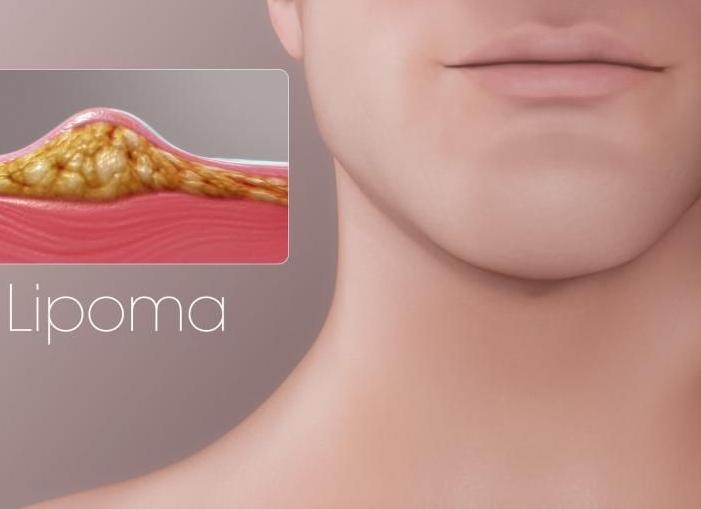 Липома на шее удаление