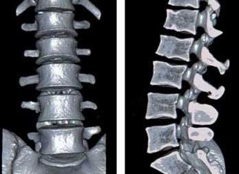 Компьютерная томография пояснично крестцового отдела позвоночника