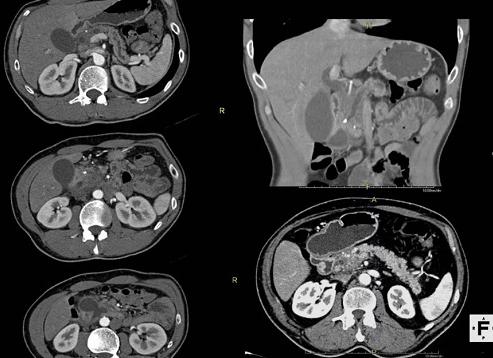 Как подготовиться к компьютерной томографии брюшной полости