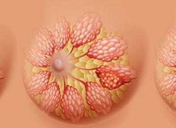 Инфильтрирующий дольковый рак молочной железы