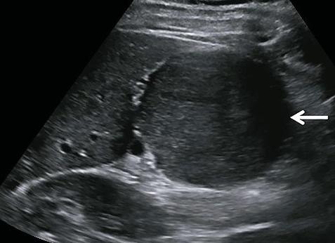 Гипоэхогенное образование в печени на узи