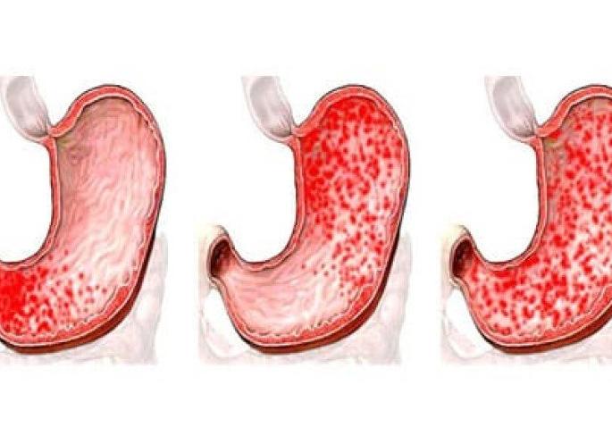 Геморрагии в желудке