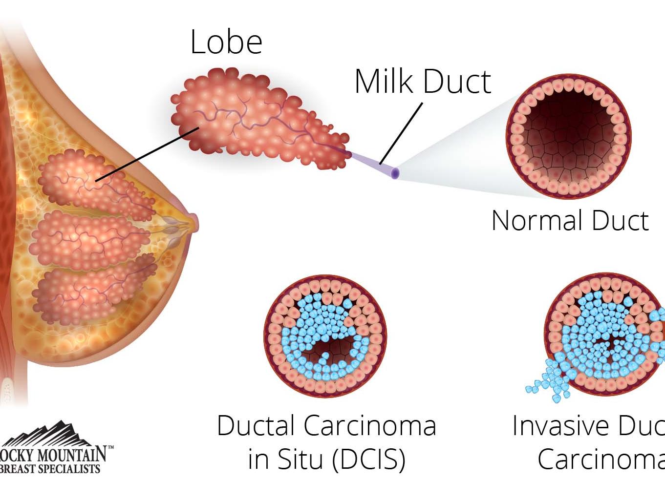 Формы рака молочной железы