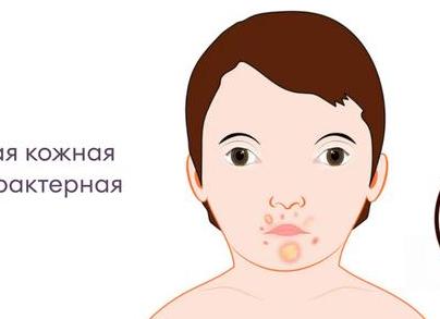 Эпидермальный стафилококк в моче причины и способы заражения