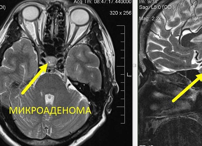 Что такое мрт гипофиза