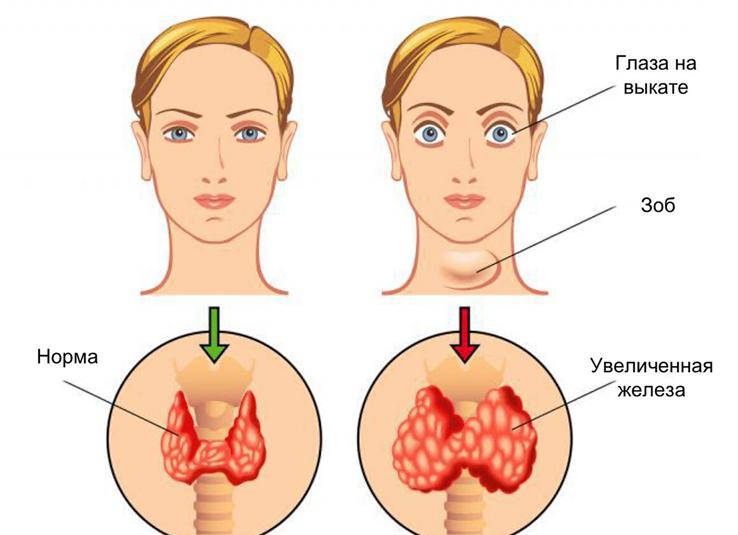 Болезни щитовидной железы связаны с избытком или недостатком гормона