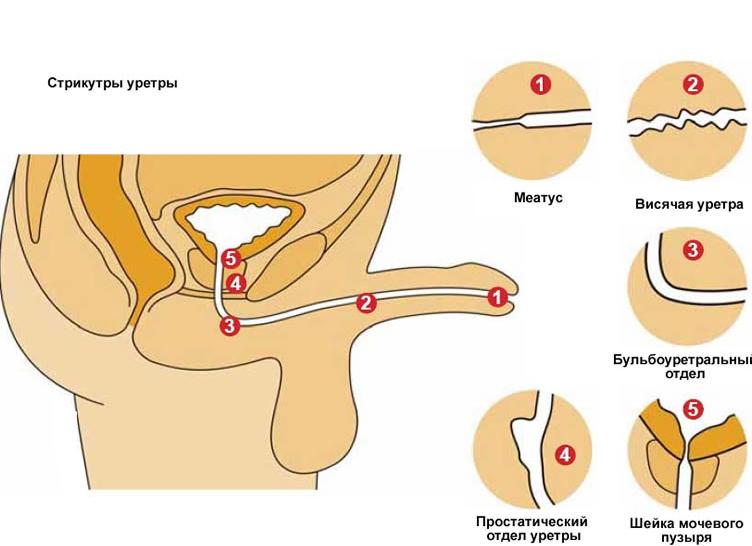Бак посев у мужчин из уретры