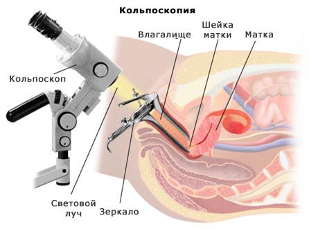Как проводится кольпоскопия шейки матки