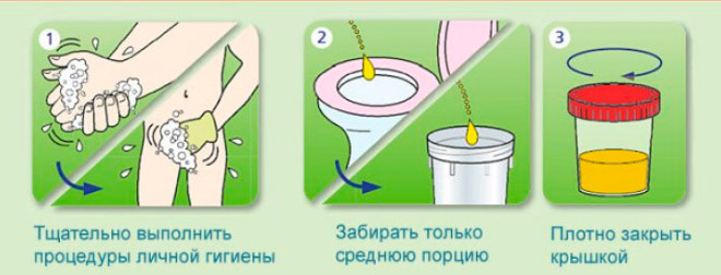 Как собрать анализ по нечипоренко
