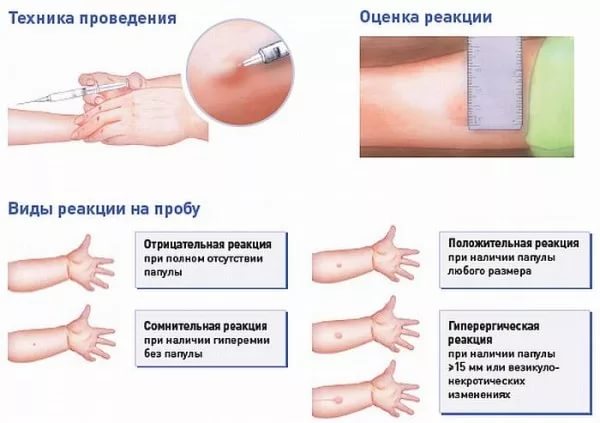 Манту у ребенка результат