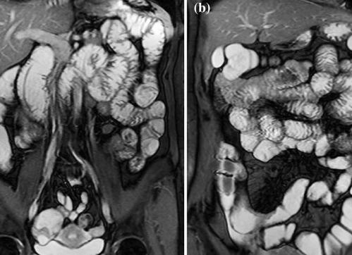 Мрт тонкого кишечника с контрастом