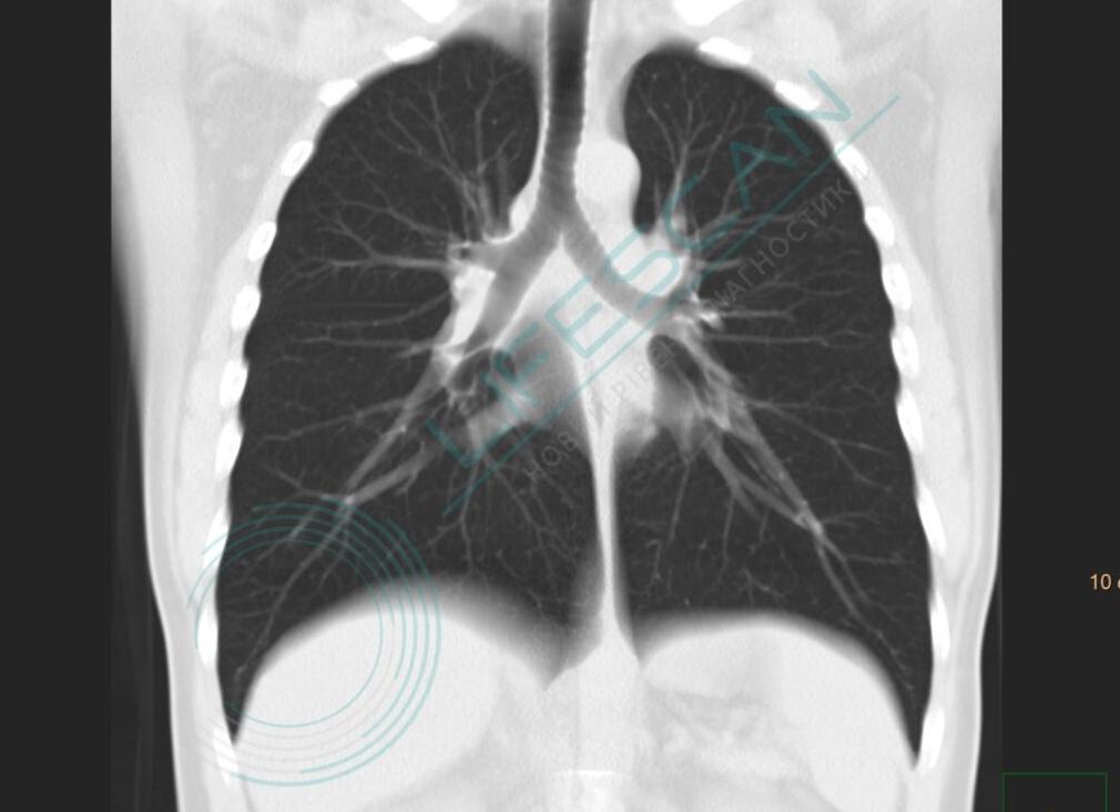 Кт бронхов и легких Кт бронхов и легких