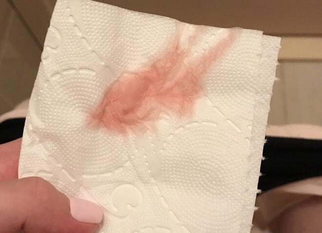 Кровянистые с неприятным запахом выделения Кровянистые с неприятным запахом выделения