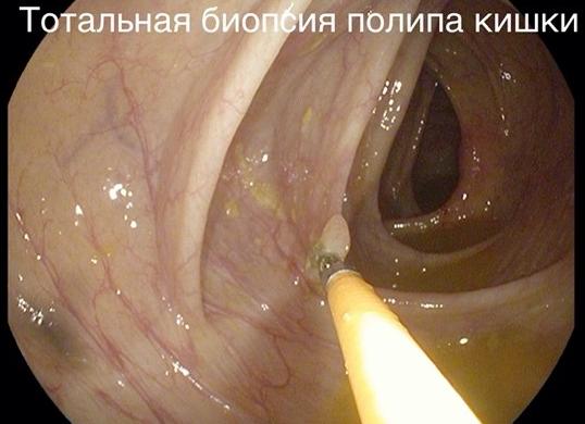 Колоноскопия тонкого кишечника