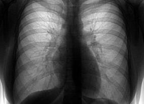 Флюорография расшифровка результатов