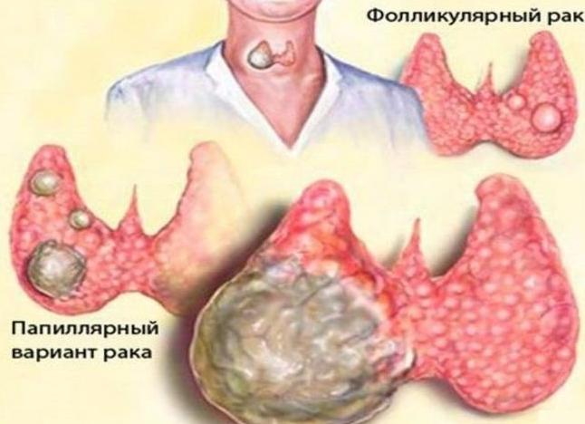 Щитовидка с правой стороны больше