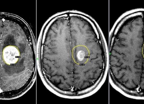 Что видно на мрт головного мозга Что видно на мрт головного мозга