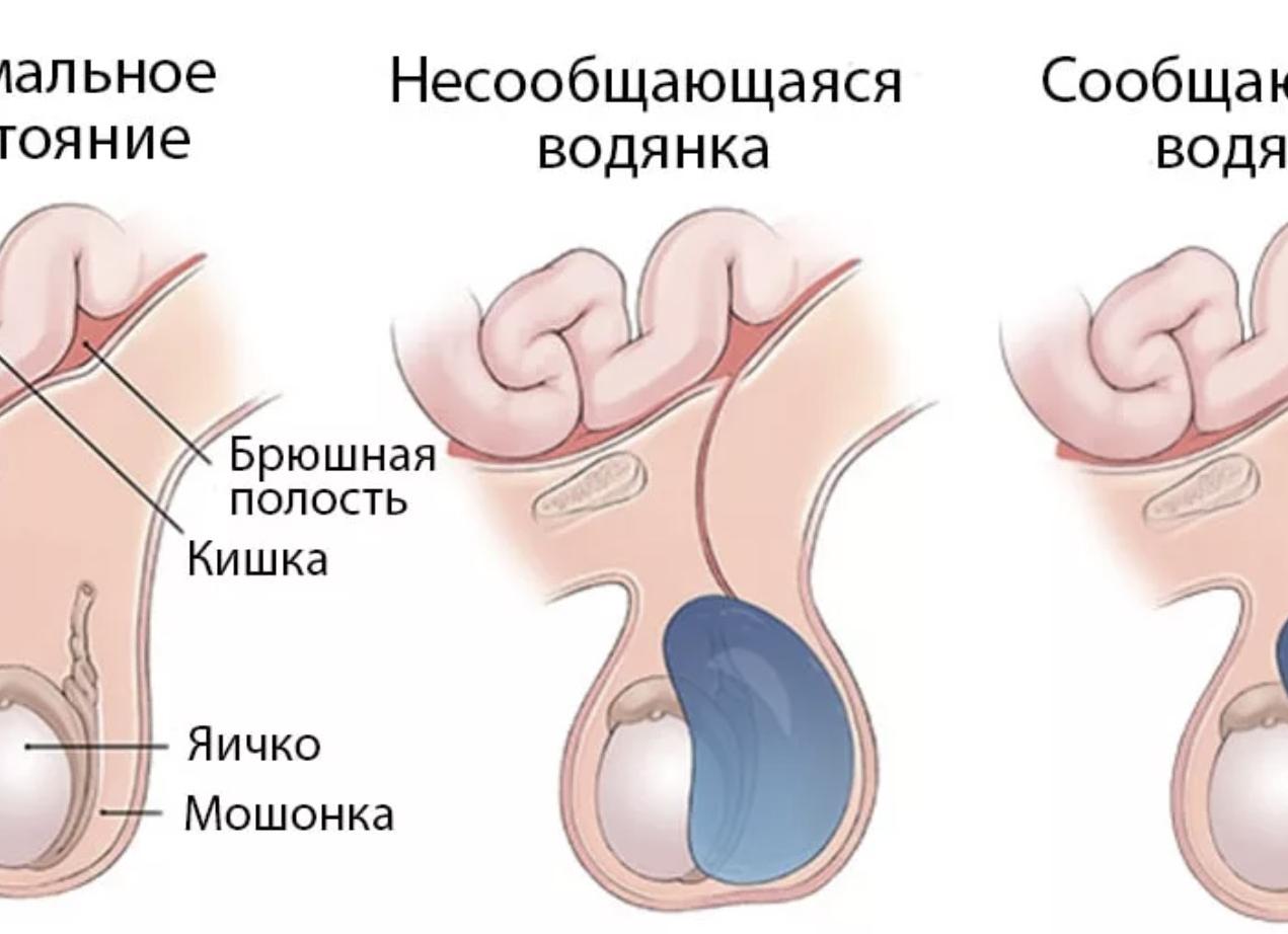 Что такое водянка яичка у мальчика Что такое водянка яичка у мальчика