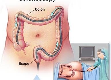 Что такое ректороманоскопия кишечника как проводится Что такое ректороманоскопия кишечника как проводится
